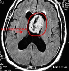 Neurocitoma 1