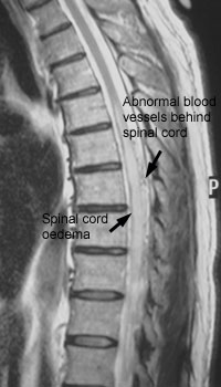 spinal mri