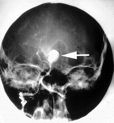 angiogram