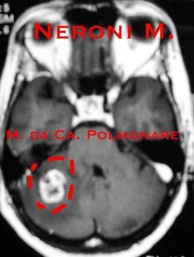 Metastasi cerebellare K Lung ax_1-2