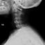 ACDF (Anterior Cervical Discectomy and Fusion)